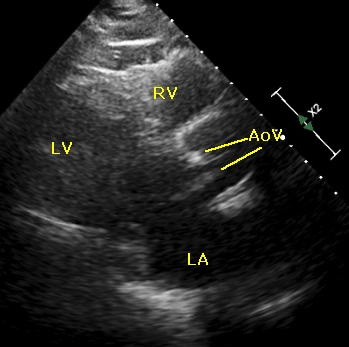 Aortic stenosis - echocardiogram