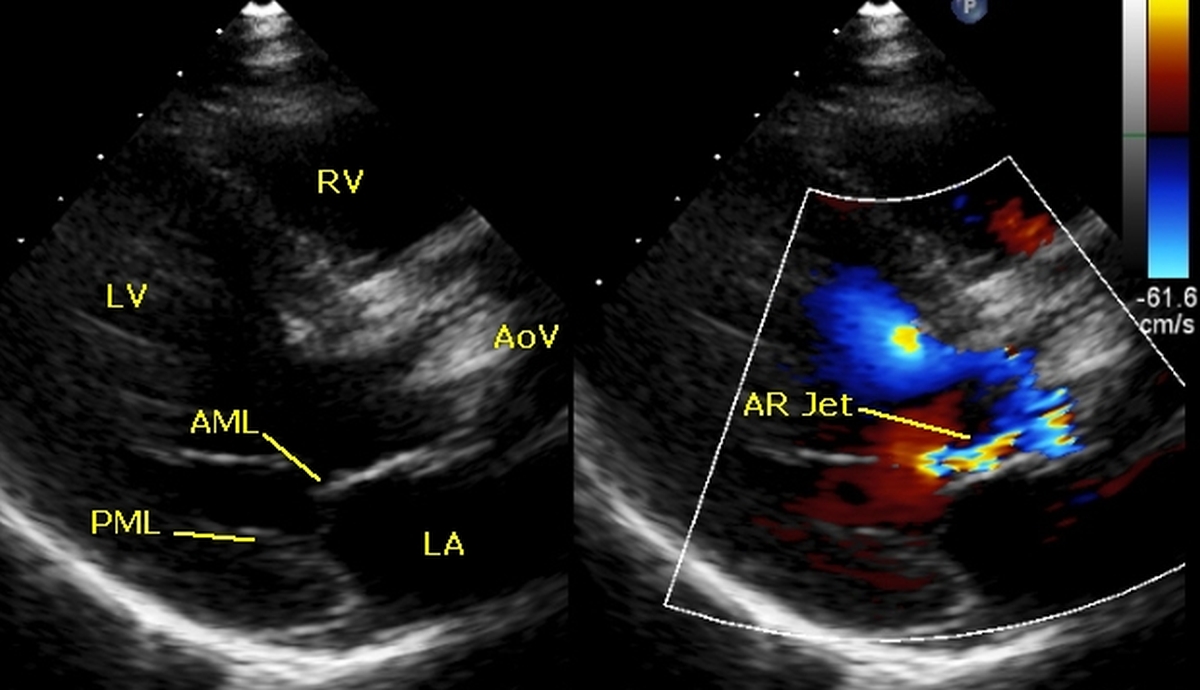 Aortic regurgitation jet in parasternal long axis view of echocardiography
