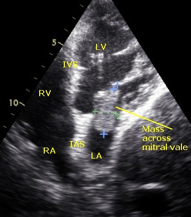 Mass across mitral valve - annotated