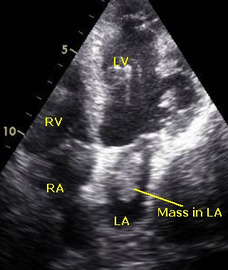 Mass in left atrium - annotated