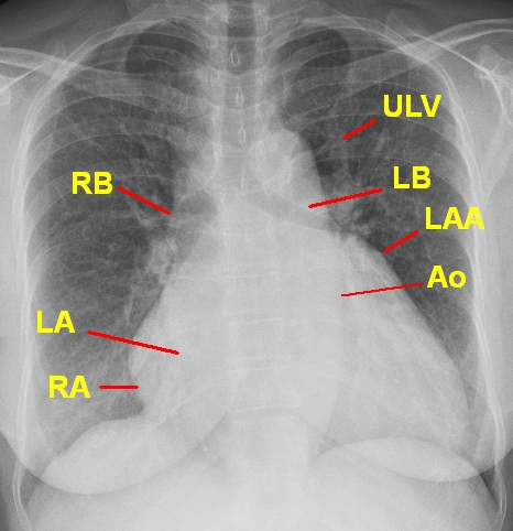 X-Ray quiz – Cardiology MCQ – Answer – All About Cardiovascular System ...