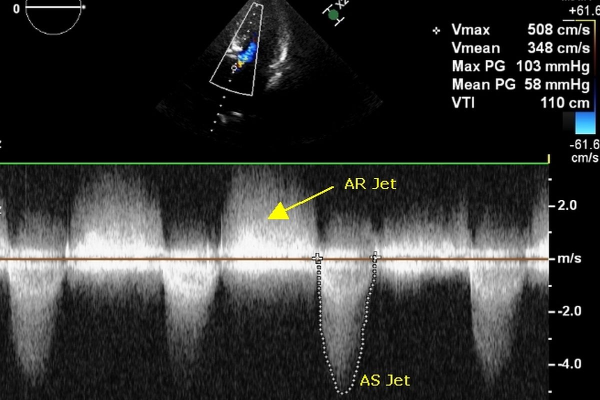 Echocardiogram – Continuous wave Doppler from apical 5 chamber view ...