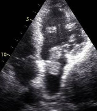 Mass across mitral valve - Apical 4 chamber view