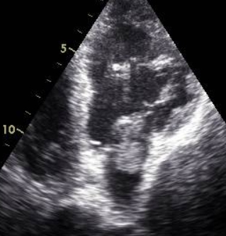 Mass across mitral valve 2 - Apical 4 chamber view