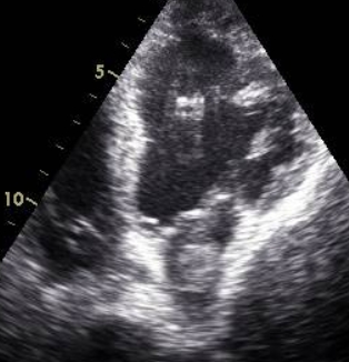 Mass in left atrium - Apical 4C view