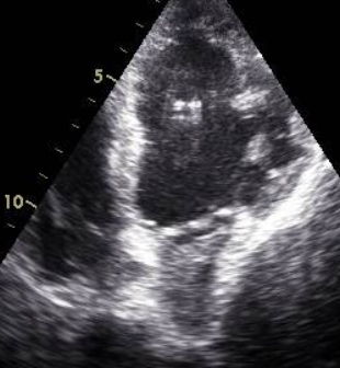 Mass in left atrium 2 - Apical 4C view