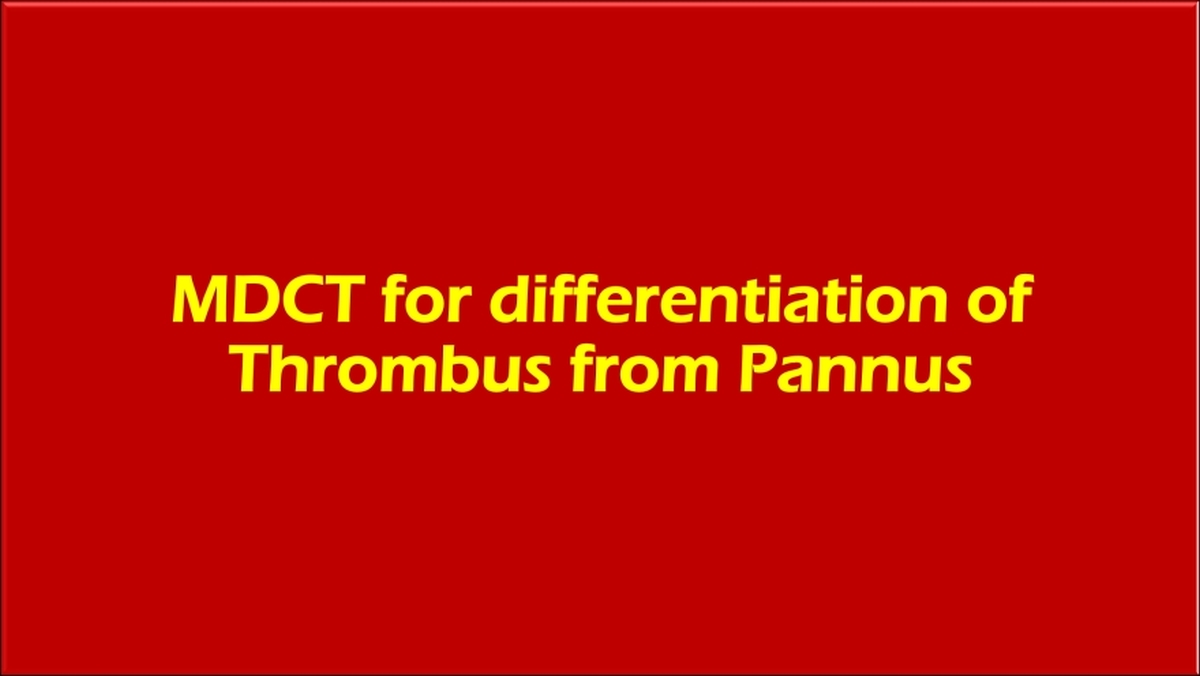 MDCT for differentiation of prosthetic valve thrombus from pannus