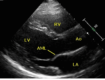 Parasternal long axis view in echocardiogram - animated view