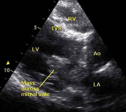 Mass across left atrium - annotated - PLAX view