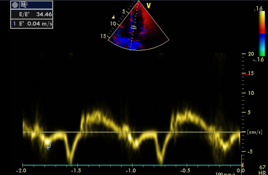 LV diastolic patterns measured by transmitral Doppler of the