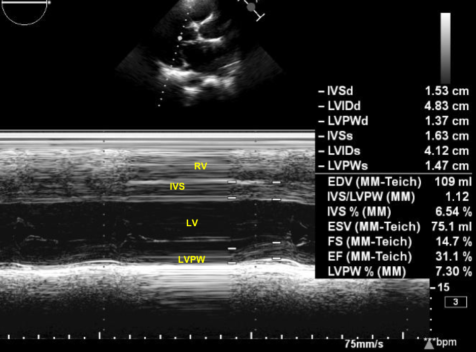 M-mode echocardiogram in left ventricular dysfunction
