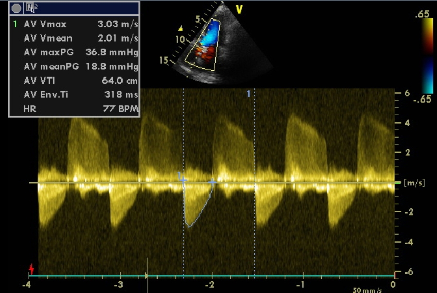 Doppler echocardiography in aortic stenosis