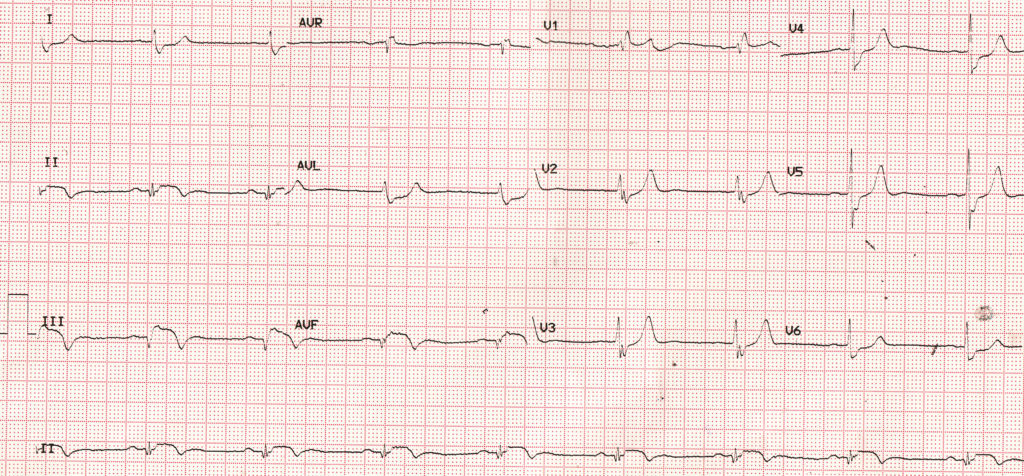 Evolved inferior wall myocardial infarction - ECG