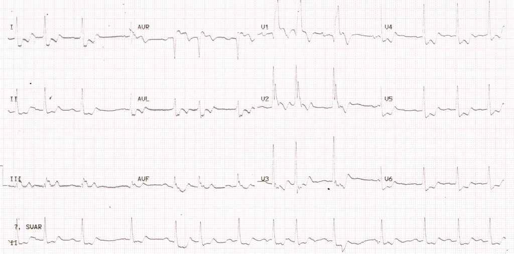 Left main coronary artery disease on ECG