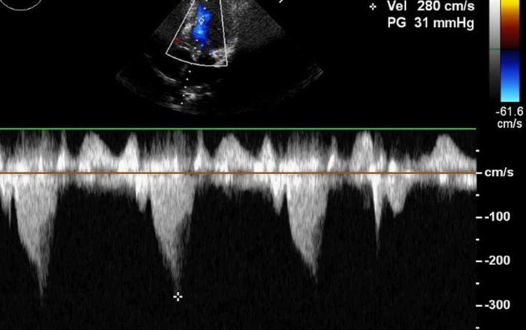 LVOT gradient in HOCM – Doppler echocardiogram – All About