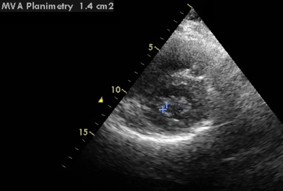 Mitral valve area by planimetry on echocardiogram