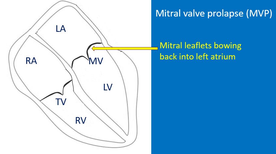 Mitral valve prolapse