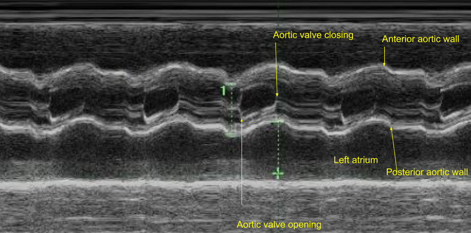 M Mode Echocardiogram Of Aorta And Left Atrium Aortic Valve Excursion