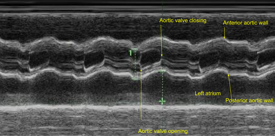 Bicuspid Aortic Valve M Mode