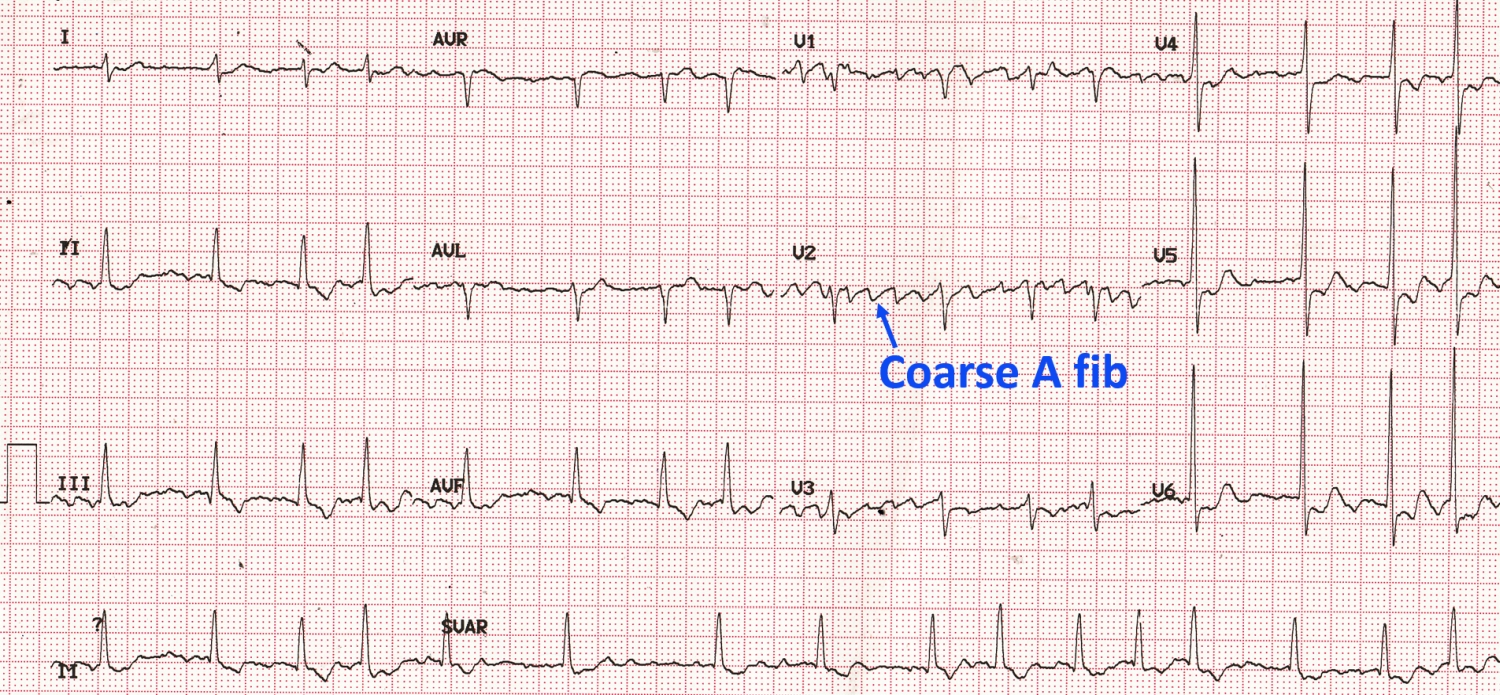 Coarse atrial fibrillation on ECG – All About Cardiovascular System and ...