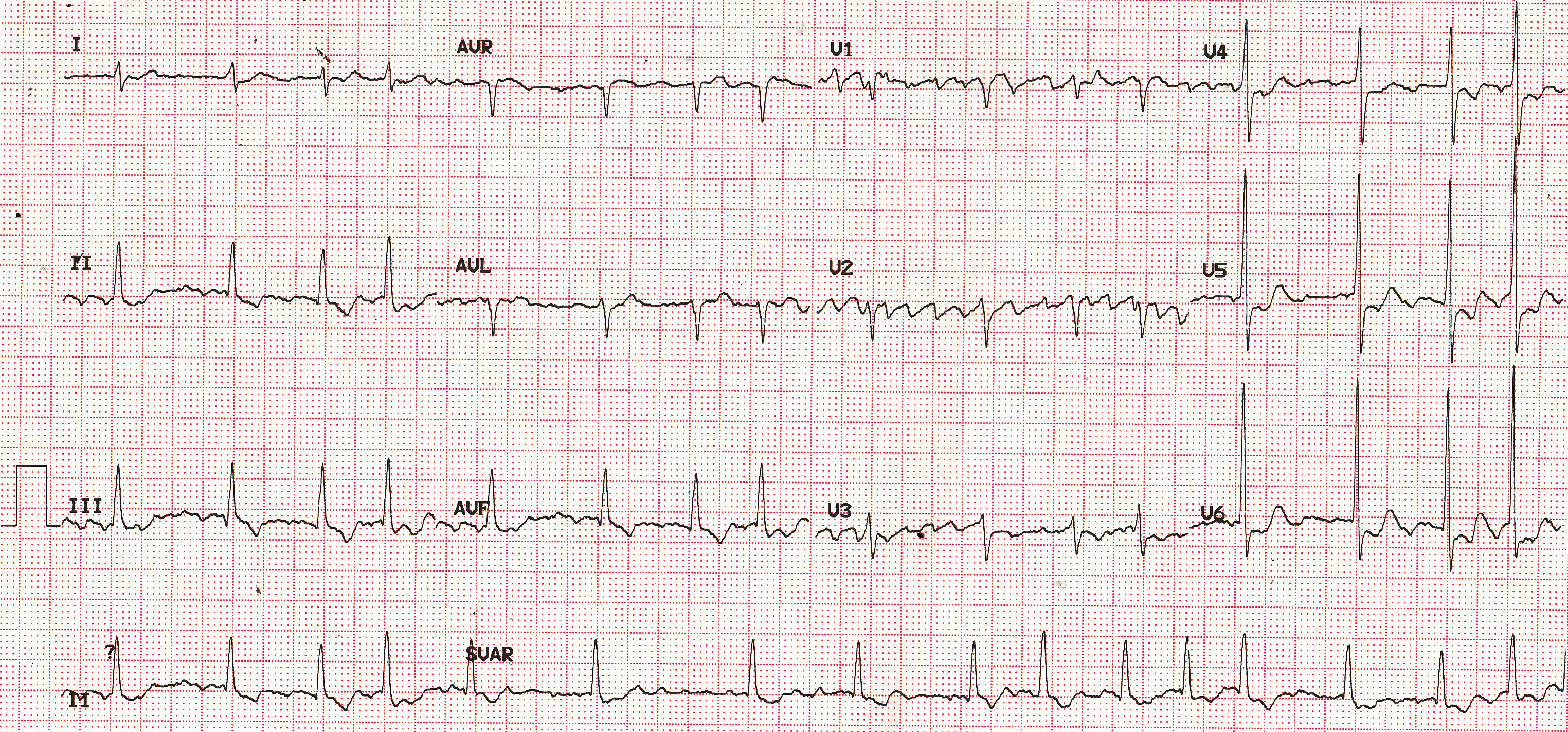 Coarse Atrial Fibrillation On ECG – All About Cardiovascular System And ...