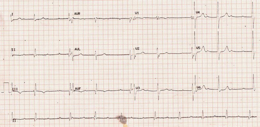 Advanced AV block with RBBB