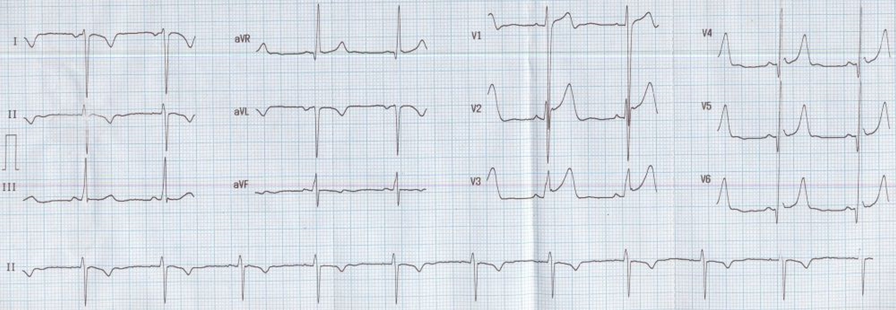 Arm lead inversion - technical dextrocardia