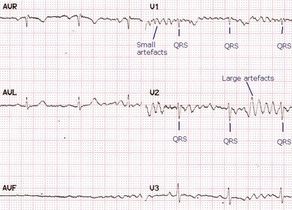 Artefacts resembling ventricular fibrillation