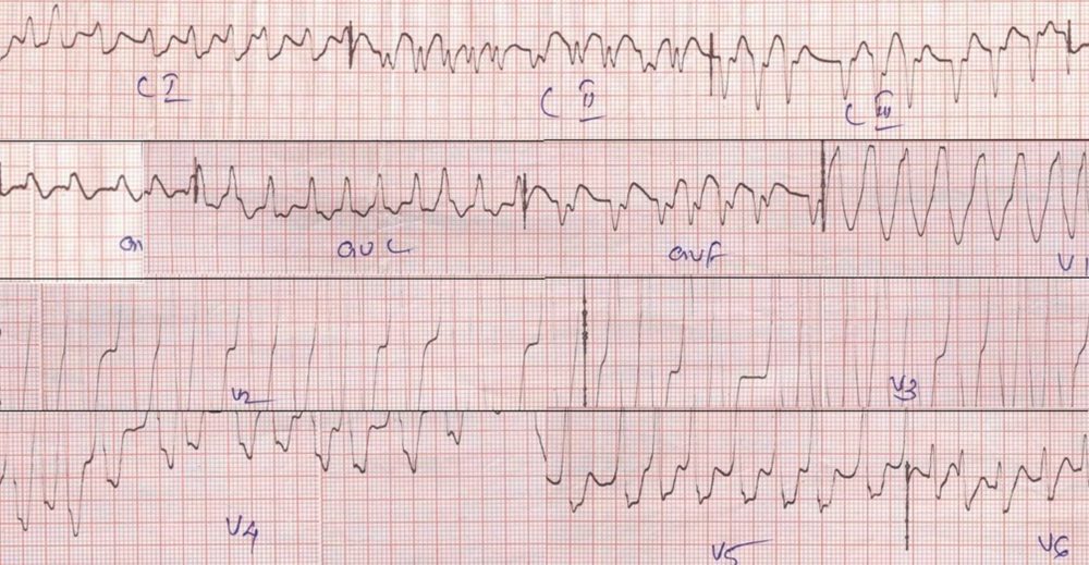 Atrial fibrillation with WPW syndrome causing a wide QRS tachycardia