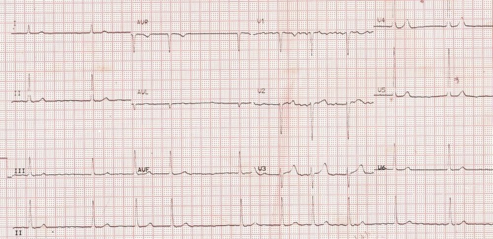 Atrial fibrillation with slow ventricular rate