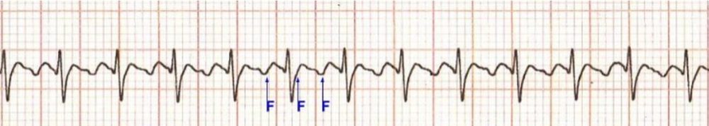 Atrial flutter with 2:1 conduction