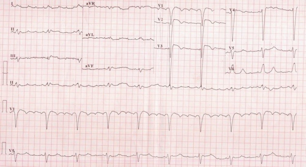 Atrial flutter with 4:1 conduction