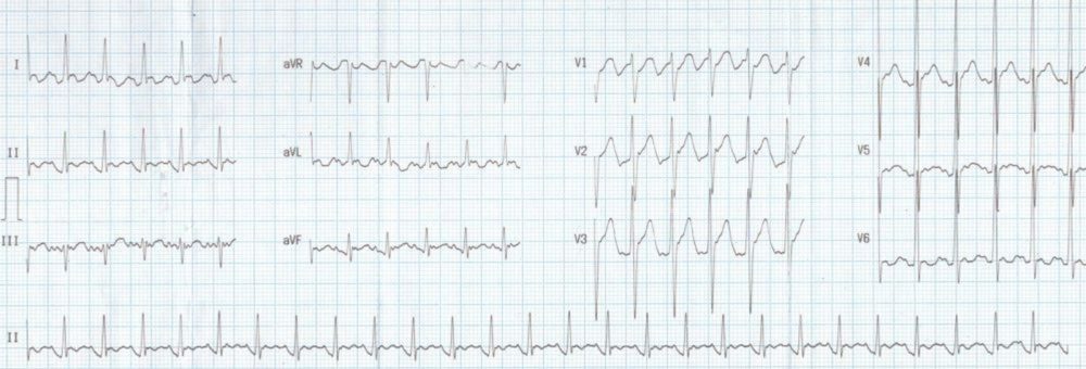 Atypical atrial flutter with 2:1 conduction