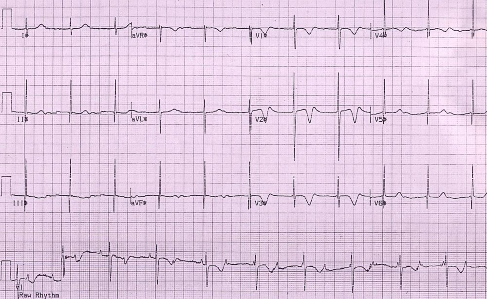 CCHB - stage 1 of exercise