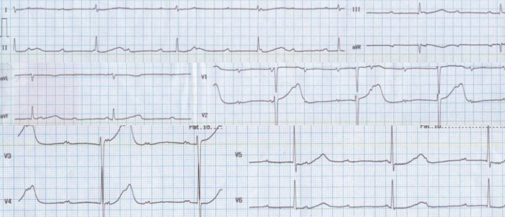 Complete heart block