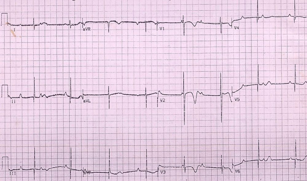 Congenital complete heart block