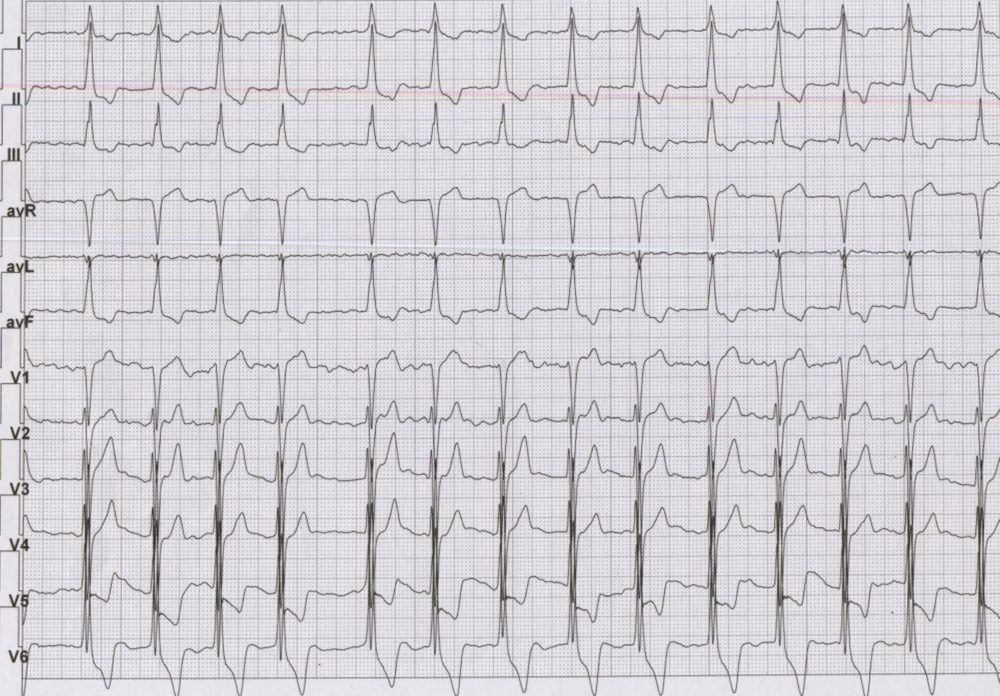 ECG in hypertrophic cardiomyopathy with atrial fibrillation
