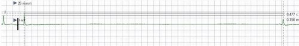 ECG rhythm strip documenting a long sinus pause of around 8.5 seconds