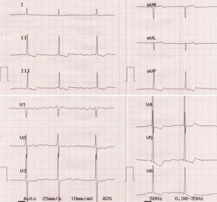 ECG showing atrial fibrillation with slow ventricular rate and left ventricular hypertrophy