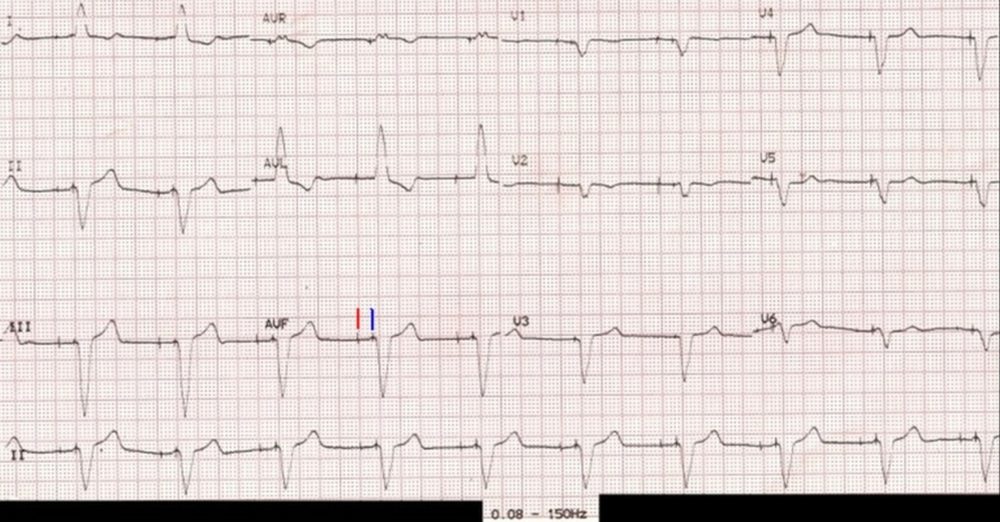 ECG with filter range 0.08 – 150 Hz – pacemaker spikes visible