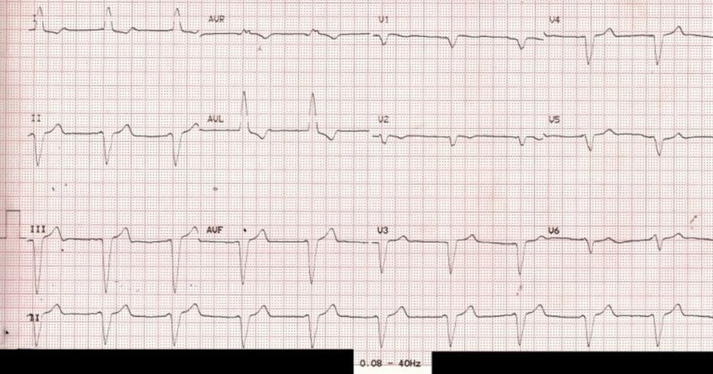 ECG with filter range 0.08 – 40 Hz – pacemaker spikes not visible