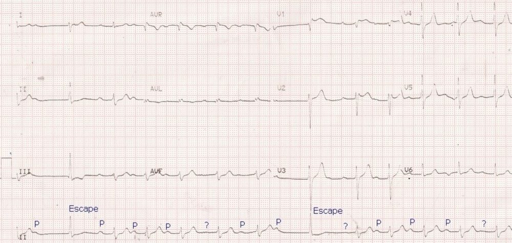 Intermittent AV block with escape beats