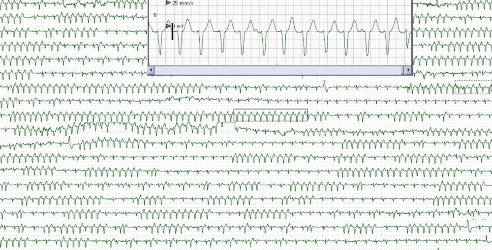 Monitor screenshot showing frequent runs of nonsustained ventricular tachycardia