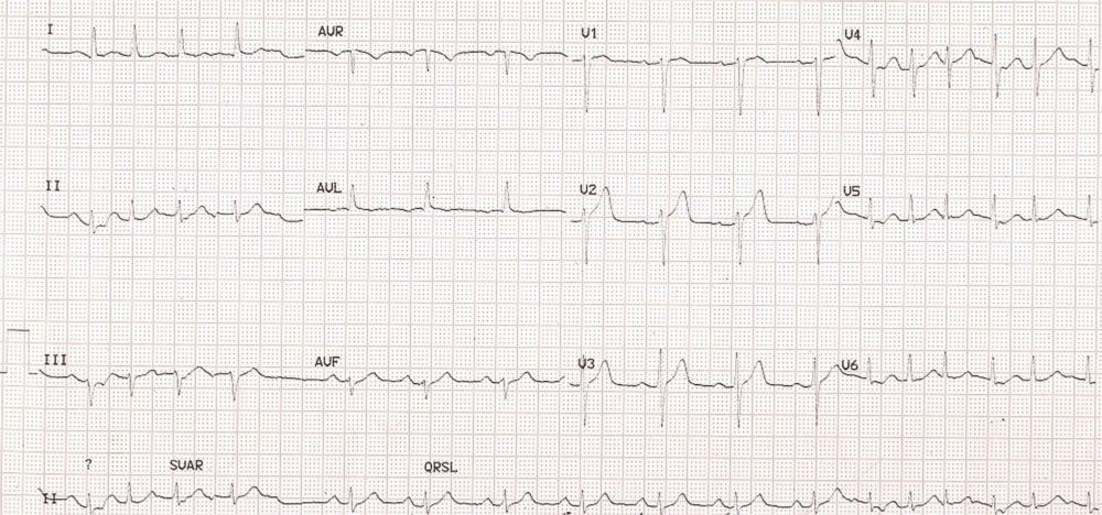 Multifocal atrial tachycardia and blocked atrial ectopic beat