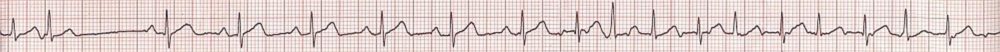 Supraventricular Arrhythmia Part 1 All About Cardiovascular System And Disorders 