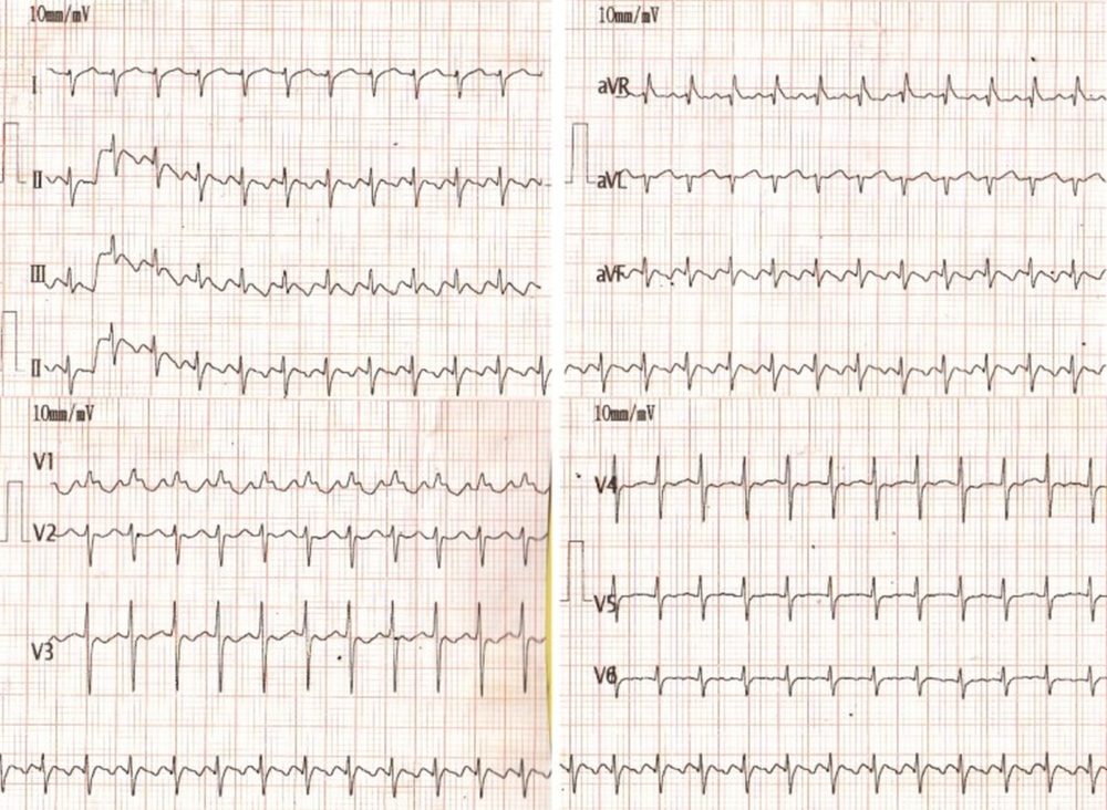 Neonatal atrial flutter with 2:1 conduction