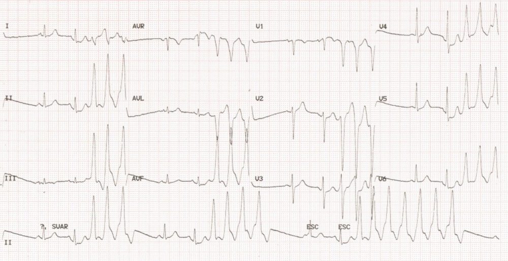 Nonsustained ventricular tachycardia (NSVT)