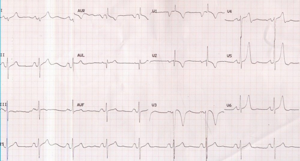 P mitrale and right ventricular hypertrophy