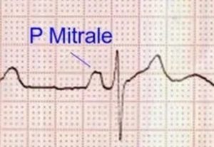 P mitrale in left atrial enlargement