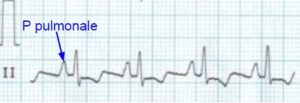 P pulmonale in right atrial enlargement